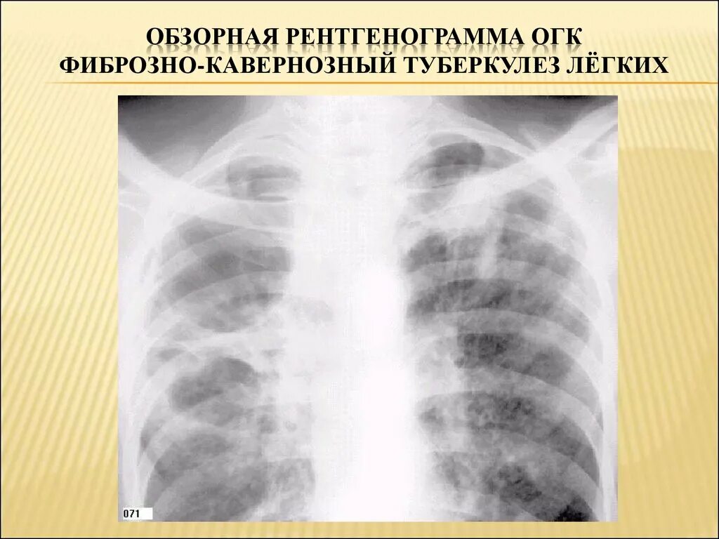 Фиброзно очаговый туберкулез легких. Фиброзно кавернозный туберкулез рентгенограмма. рентген снимок фиброзно кавернозный туберкулез. обзорная рентгенограмма огк. кавернозный туберкулез рентген.