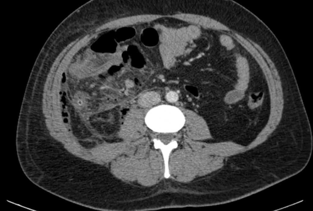 Подпеченочный абсцесс. Аппендикулярный инфильтрат на кт. Аппендикулярный абсцесс кт. Межпетельный абсцесс кт. Подпеченочный абсцесс СКТ.
