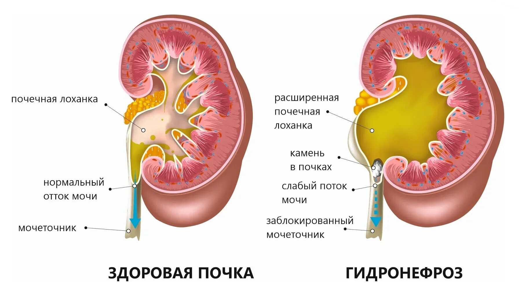 Расширена лоханка почки у взрослых что значит. Расширена лоханка почки у взрослых что значит