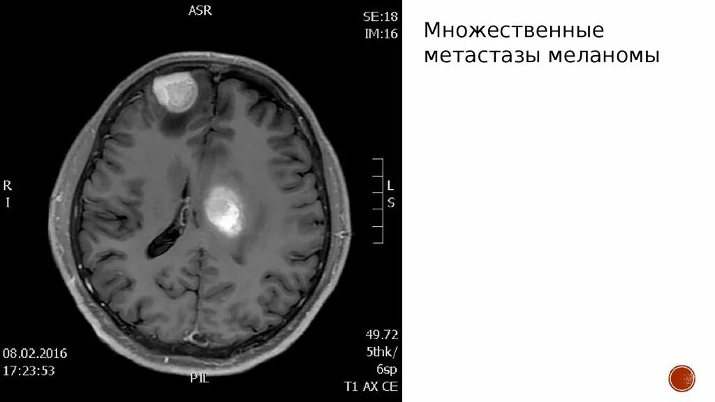 Меланома метастазы в мозг. Метастазы меланомы в головной мозг мрт. Метастазы головного мозга кт. Меланома на кт головного мозга.