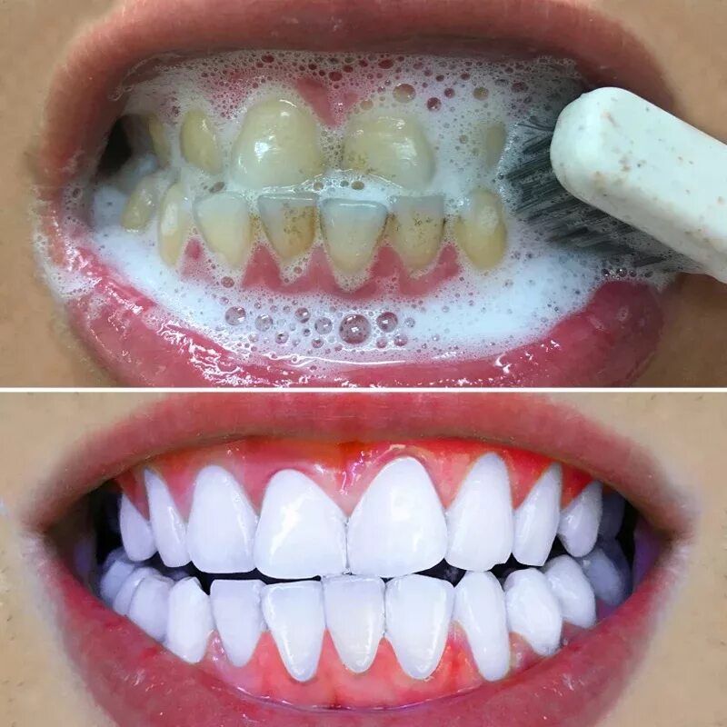 Можно курить после стоматолога. Эмаль для отбеливания зубов. Отбеливание зубов содой.