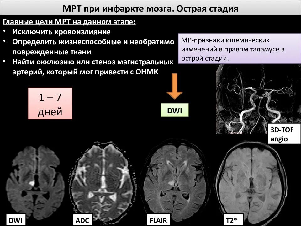 Стадии ишемии головного. Ишемический инсульт мрт. Мрт головного мозга при ОНМК. Ишемический инсульт мрт Dwi. Стадии ОНМК на кт.