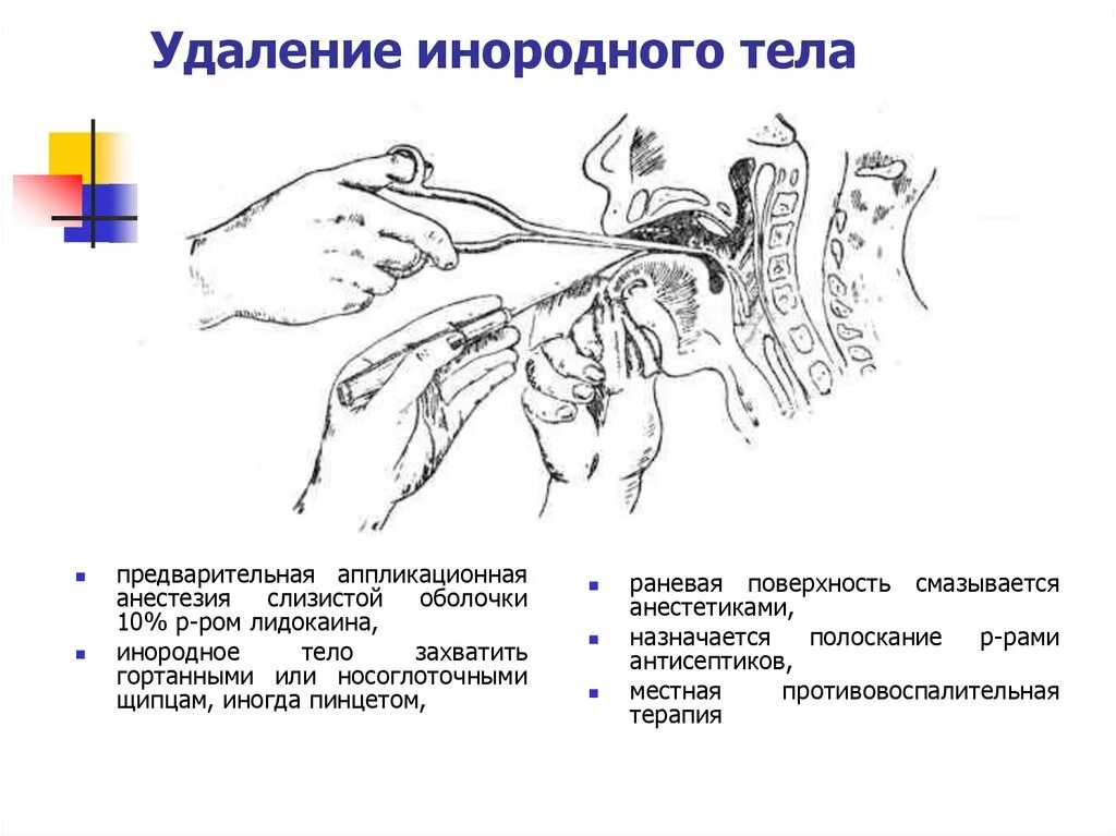 Инородные тела в глотке первая помощь. Удаление инородного тела. Удаление инородного тела из глотки. Удаление инородного тела алгоритм. Инородные тела глотки классификация.