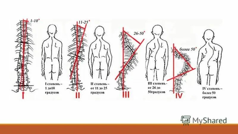 Искривление позвоночника градусы. Степени сколиоза по градусам. Угол сколиоза. Угол искривления позвоночника 16 градусов. Сколиоз 16 градусов степень.