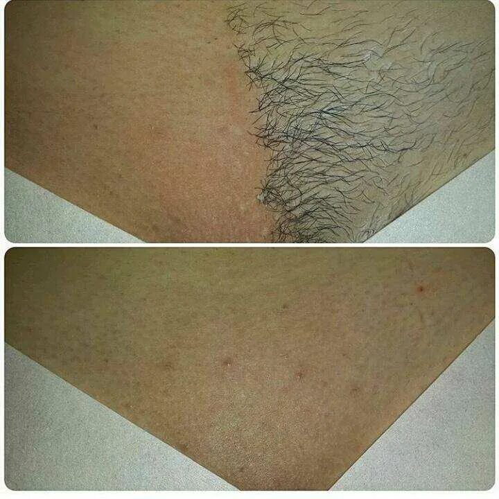 Лазерная эпиляция ягодиц. Лазерное бикини глубокое видео. Лазерное бикини глубокое видео. Лазерная эпиляция. Эпиляция зоны бикини александритовым лазером.