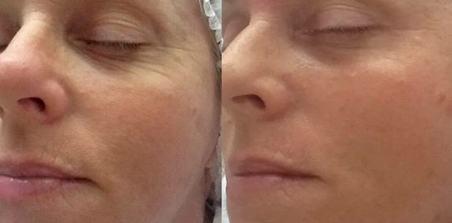 Микроигольчатая мезотерапия. Электрический мезороллер. Дермапен отзывы о процедуре. Безинъекционная фракционная мезотерапия. Дермапен отзывы о процедуре.