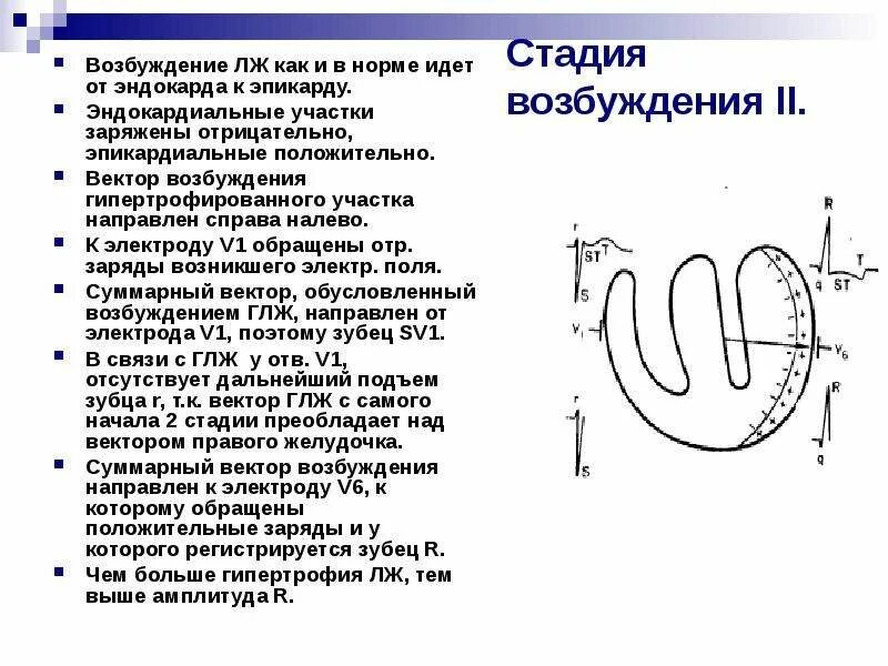 Гипертоническая болезнь 2ст аг 2ст. Синдром гипертрофии миокарда левого желудочка на экг. Гипертрофия миокарда левого желудочка при гипертонической болезни. Концентрический тип гипертрофии левого желудочка. Гипертрофия миокарда левого желудочка при гипертонической болезни.