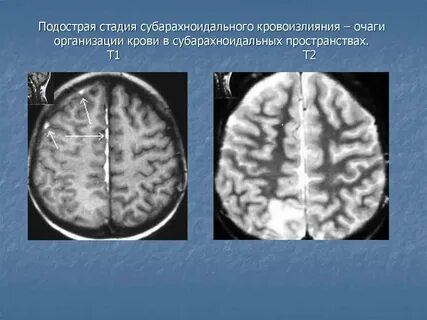 Субарахноидальный инсульт
