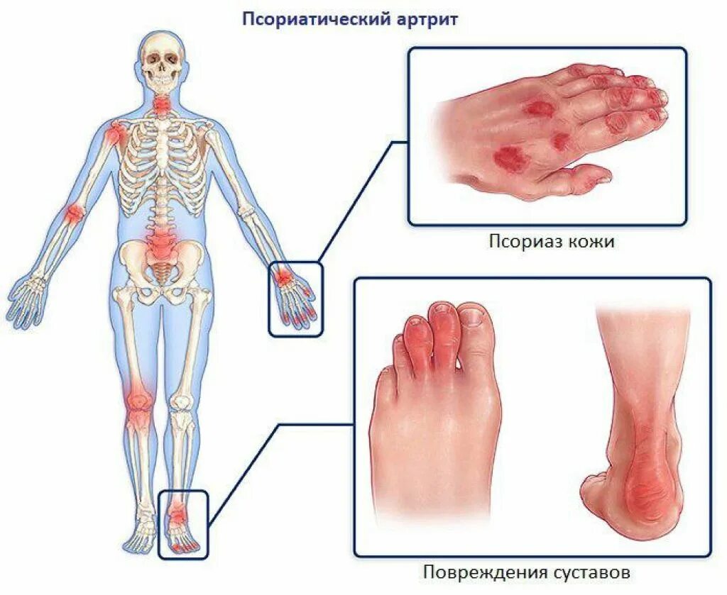 Ревматическое поражение суставов