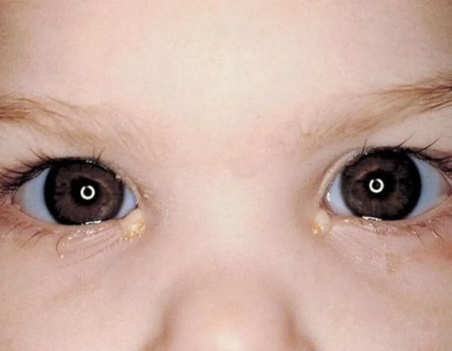 Конъюнктивит у новорожденного. Конъюнктивит у новорожденн. Глаза ребенка.