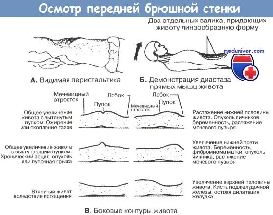Как осматривать живот. Осмотр передней брюшной стенки. видимая перистальтика живота.