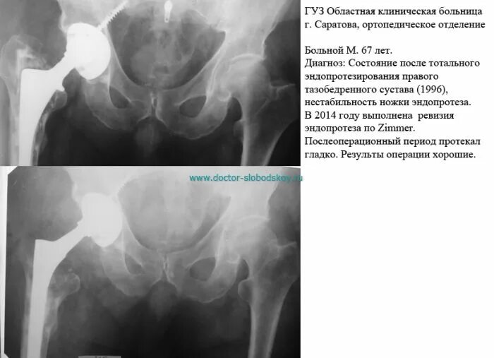 После тазобедренного. Больничный лист при эндопротезировании тазобедренного сустава. шов при эндопротезировании тазобедренного сустава. реабилитация после ревизионного эндопротезирования. жизнь после эндопротезирования тазобедренного сустава.