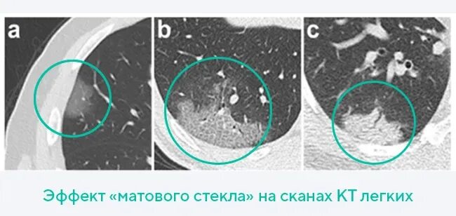 Крупозная пневмония кт. Матовое стекло на кт при коронавирусе. Легкие на кт при коронавирусе. Матовые стекла на кт легких.