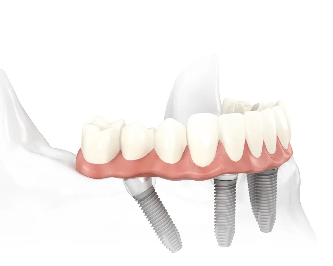 имплантация челюсти на 4 имплантах. временный несъемный протез на импланты. протезы на 4 х имплантах. имплантаты dentium superline. All on 4 имплантация нобель.