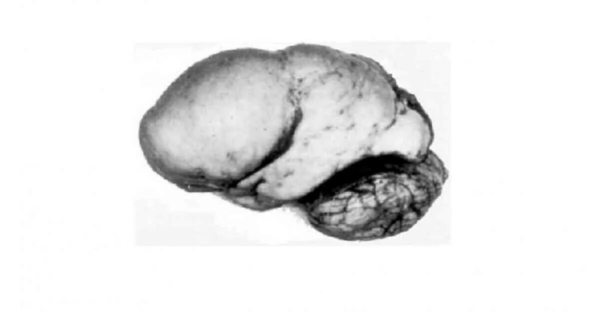 Миллера дикера. Лиссэнцефалия-пахигирия. Миллера-Дикера лиссэнцефалия. Лиссэнцефалия головного мозга у плода. Агирия головного мозга.