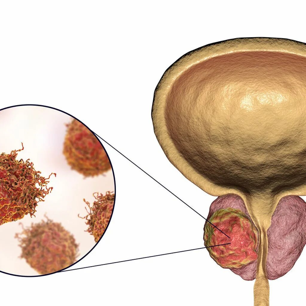 Бактерии простаты. Злокачественное новообразование предстательной железы. Хронический эпидидимит фото. Бактериальный простатит фото. Простатит вектор.