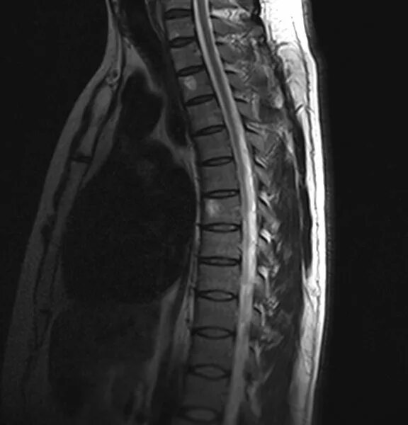 гемангиома позвоночника мрт. мрт позвоночника гемангиома с7. гемангиома грыжа позвоночника. гемангиома грыжа позвоночника. что такое гемангиома позвоночника поясничного отдела l3 позвонка.