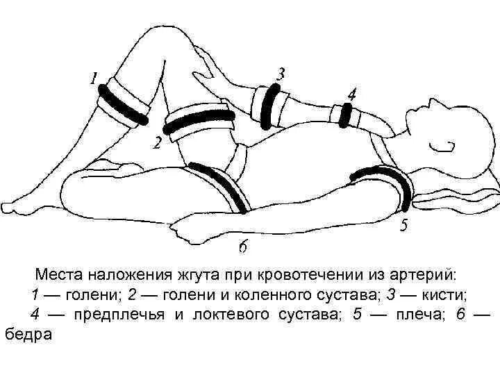 Виды жгутов при кровотечении. Виды жгутов при кровотечении