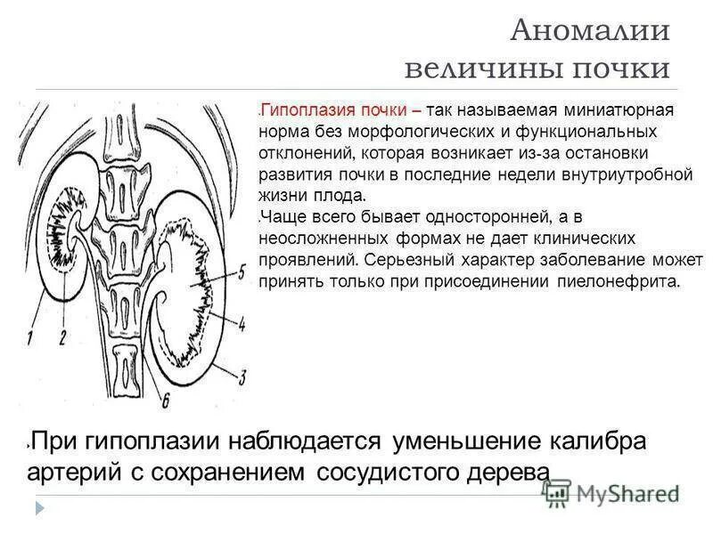 Признаки гипоплазии почки на УЗИ. Гипоплазия почки гистология. Аномалии почек гипоплазия. Гипоплазия почки причины. Правая почка меньше левой