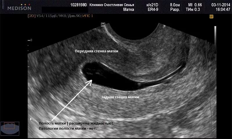 Что значит расширенная полость матки. Полип эндометрия в матке на УЗИ. Серозометра эндометрия.