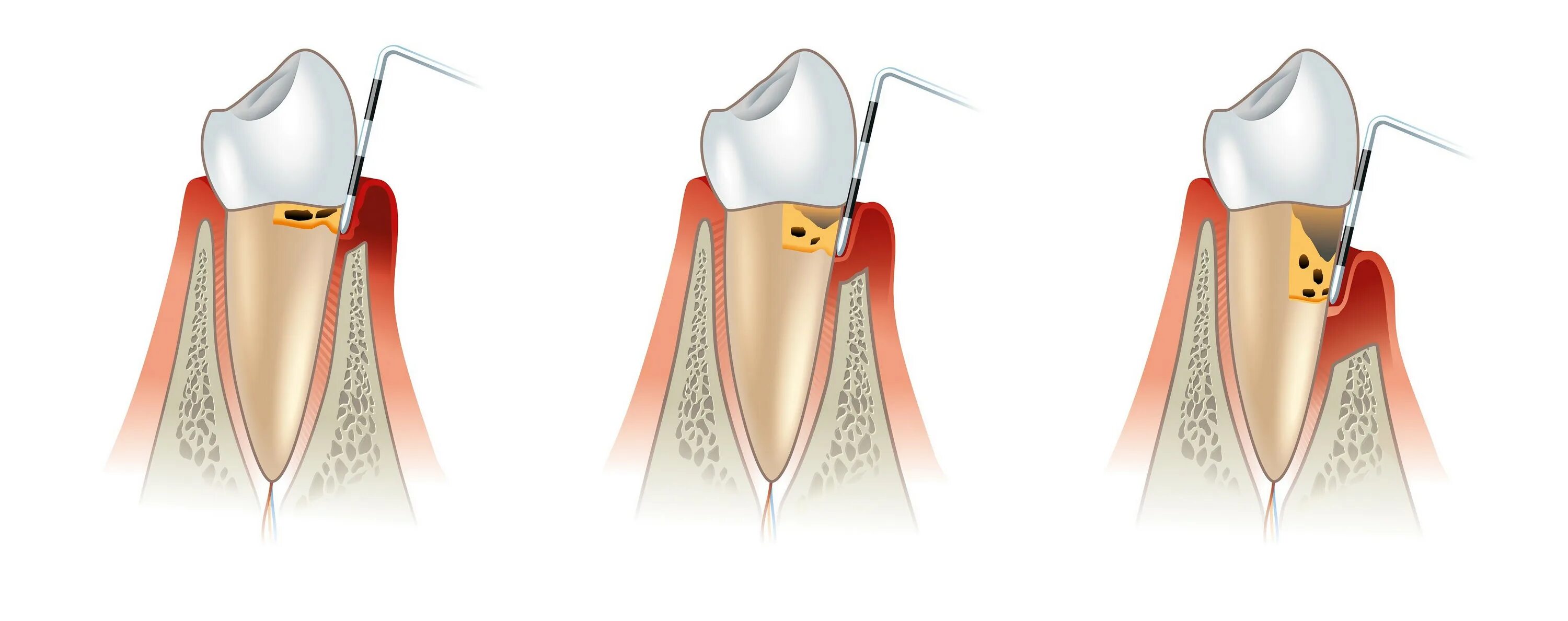 Зондирование пародонтальных карманов. Кюретаж пародонтальных карманов. Кюретаж пародонтальных карманов зуба. Кюретаж пародонтальных карманов в области.