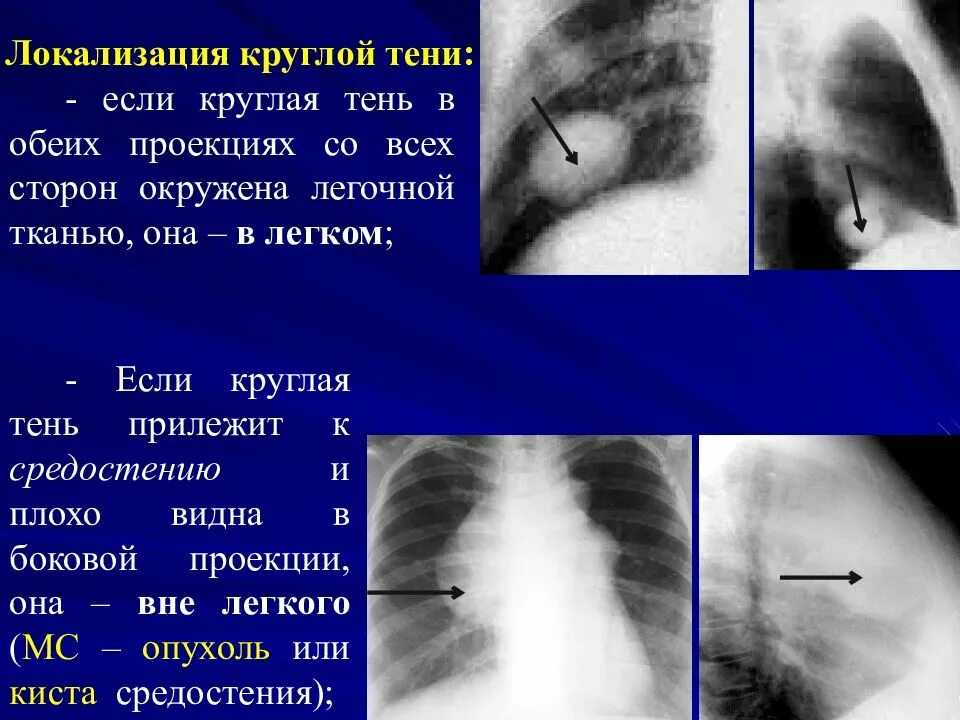 Круглая тень в легочном поле. Синдром круглой тени на рентгенограмме легких. Округлое затемнение