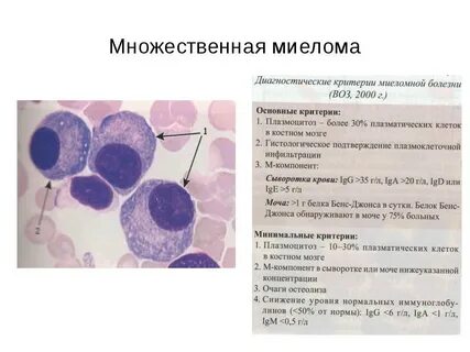 Миеломная болезнь лейкоз