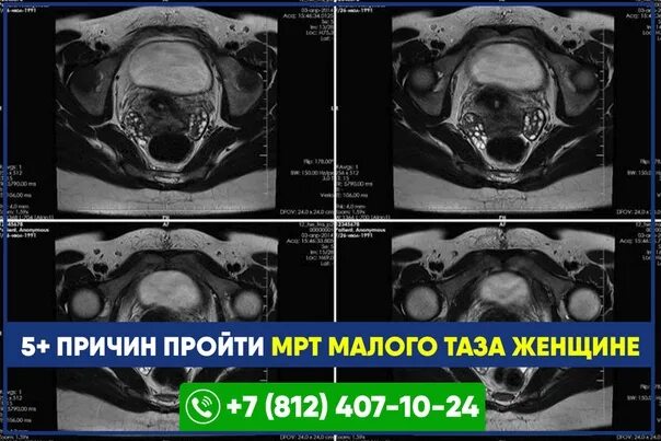 Мрт малого таза спб адреса. Мрт малого таза Сергея Березина. Мрт малого таза у женщин. Компьютерная томограмма малого таза. Подготовка к мрт малого таза.