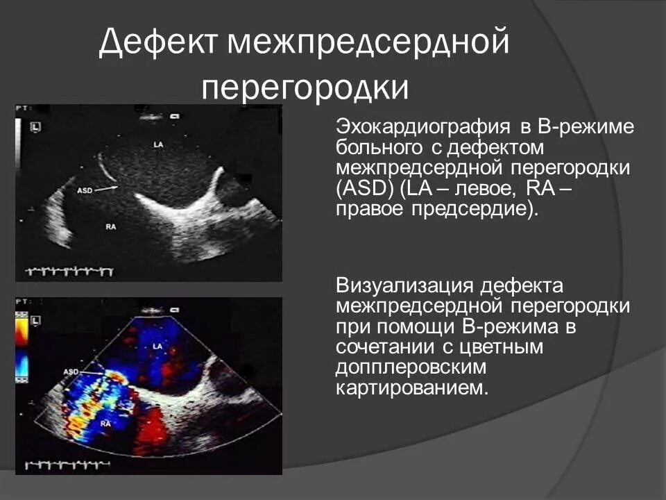 Аневризма перегородки у ребенка. Дефект межпредсердной перегородки ЭХОКГ. Эхокардиография при ДМПП. Дефект межпредсердной перегородки эхокардиография. Дефект межжелудочковой перегородки ЭХОКГ.