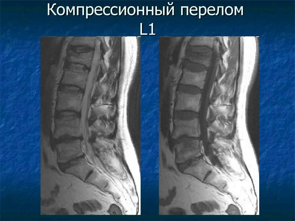 Повреждения позвоночника переломы. Компрессионный перелом позвоночника l1. Компрессионный перелом позвоночника l5. Компрессионный перелом позвоночника l1 поясничного отдела. Компрессионный перелом поясничного позвонка мрт.