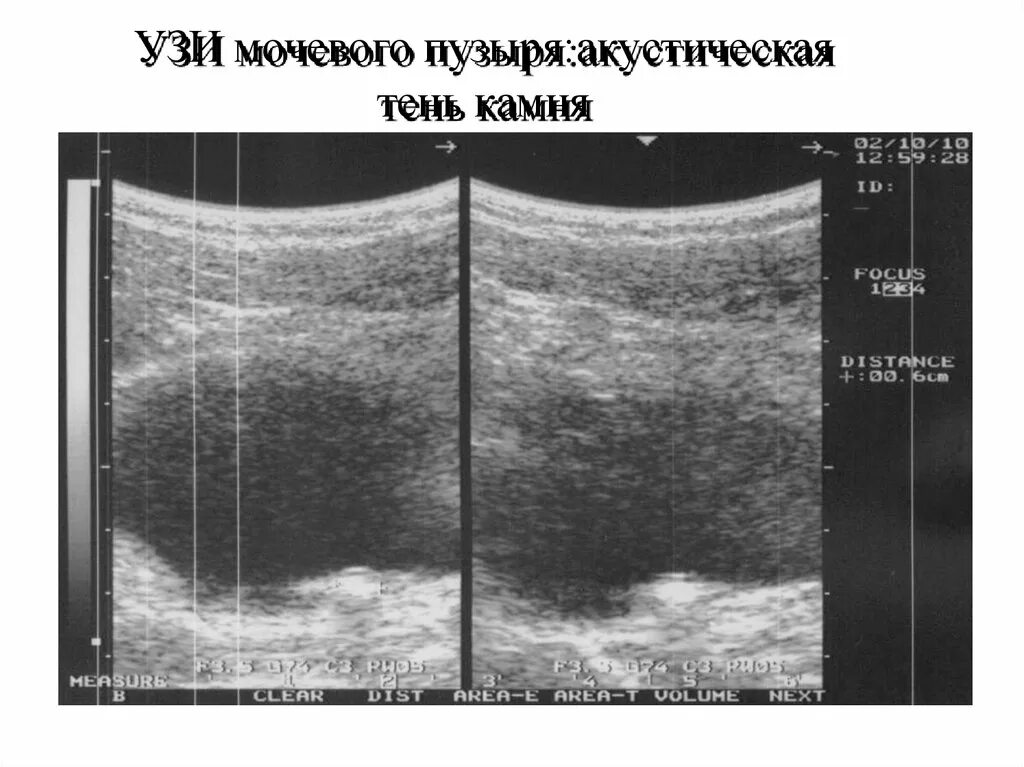 Акустические тени в почках. Акустическая тень на УЗИ. Акустическая тень на УЗИ почек что это. Акустическая тень на УЗИ выглядит как. Акустическое окно в УЗИ это.