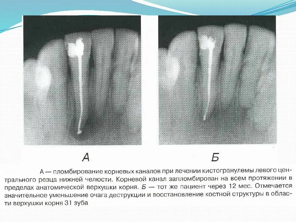 Периодонтита 3 канального зуба. Рецидивирующий периодонтит. Периодонтита трехкорневого зуба. Осложнение лечения периодонтита