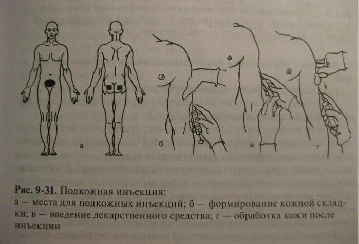 Подкожные инъекции техника выполнения. Место введения подкожной инъекции в плечо. Техника выполнения подкожных и внутримышечных инъекций. Подкожная инъекция под лопатку алгоритм. Инъекция в плечо внутримышечно техника.