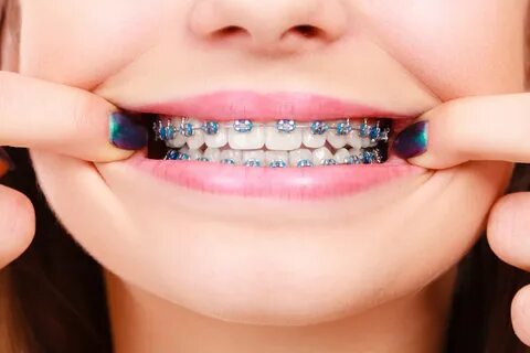 Woman showing her teeth with braces. 