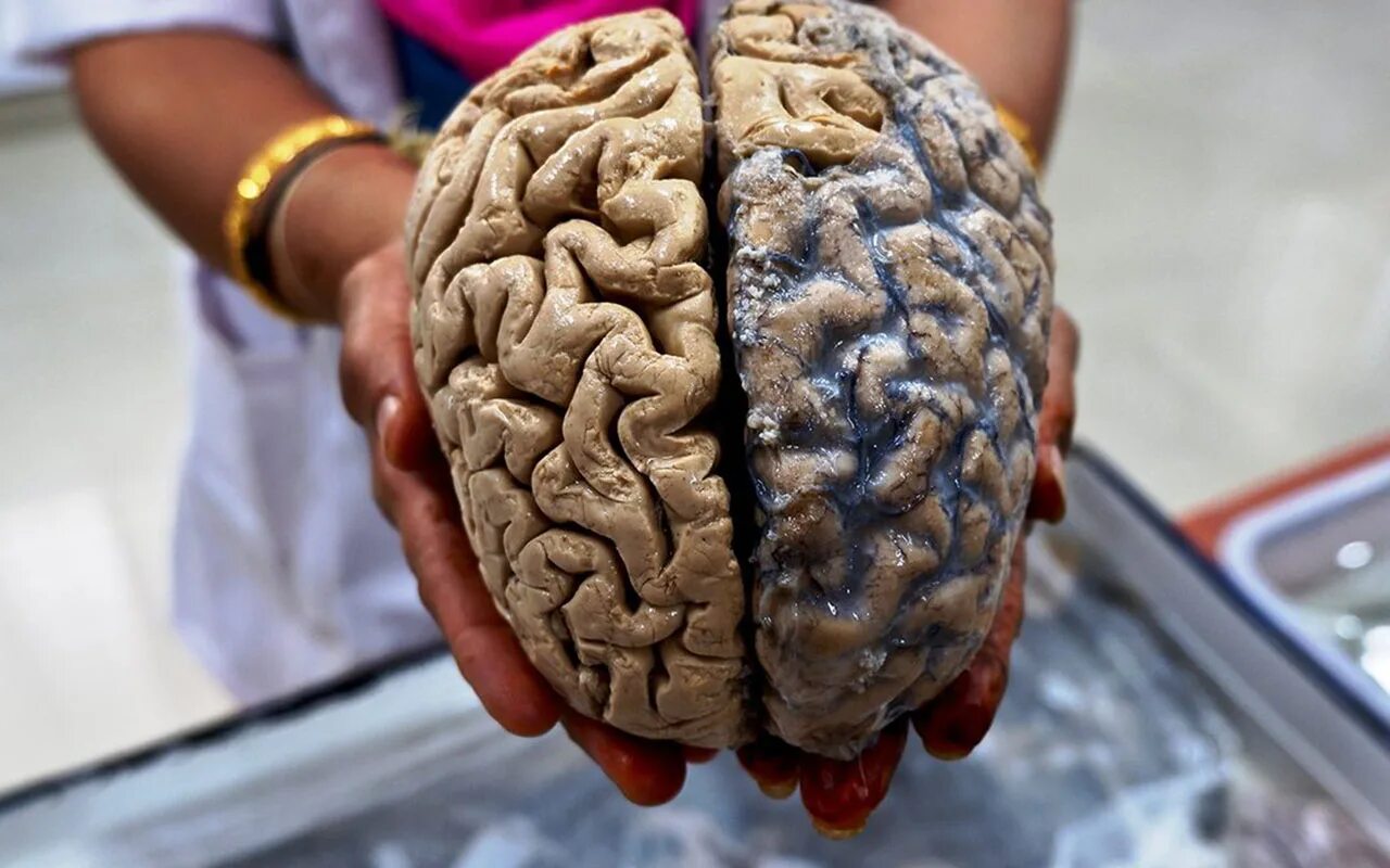 Натовщий мозг человека. Настоящий человеческий мозг.