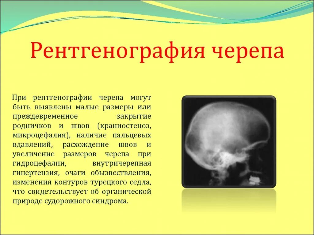 Образование кости черепа. Рентген черепа патология. Рентгенограмма черепа норма. Рентгенография костей черепа. Протокол рентгенографии черепа.