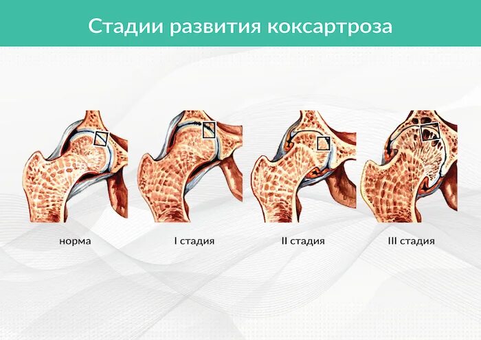Доа тазобедренного сустава 2 степени. Стадии артроза тазобедренного сустава на кт. косинская классификация коксартроза. коксартроз тазобедренного сустава классификация.