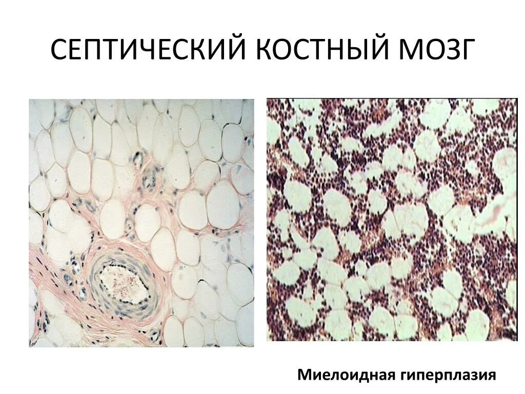 Диффузное изменение костного мозга. Костный мозг при сепсисе микропрепарат. гиперплазия костного мозга гистология. костный мозг при сепсисе. костный мозг при сепсисе гистология.