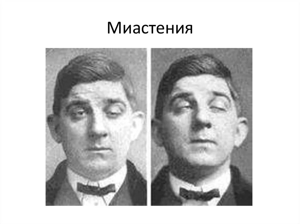 Миастения глазная форма. Глазная миастения гравис. Глазная миастения лечение. Глазная миастения лечение. Миастения гравис симптомы.