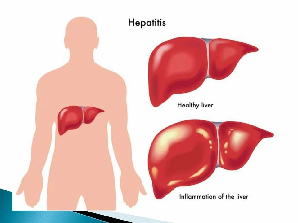 Печень пораженная гепатитом. Печень здоровая и больная.