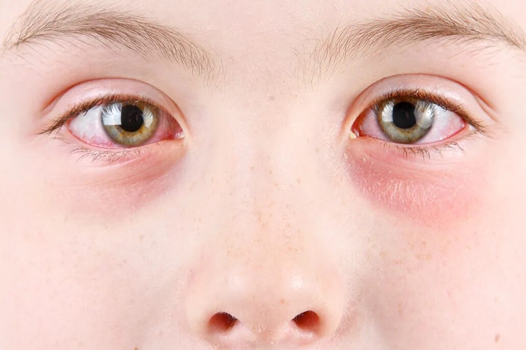 Детская глазная болезнь. Аллергический конъюнктивит. Катаральный конъюнктивит аллергический. Гонобленорейный конъюнктивит. Герпесный конъюнктивит.