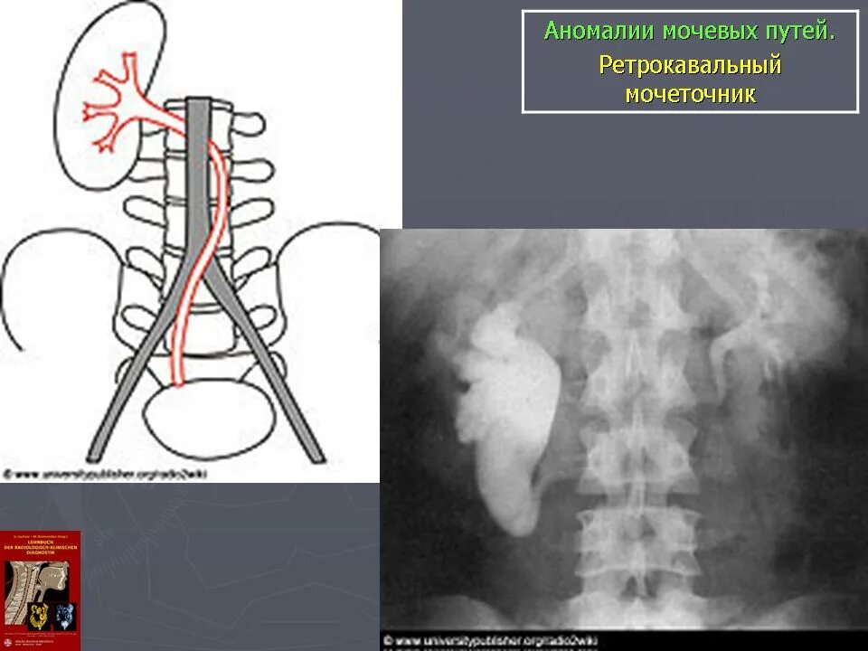 Ретрокавальный мочеточник. Ретрокавальное расположение мочеточника. Ретрокавальный и ретроилиакальный мочеточник. Аномалии развития почек.