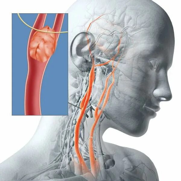 Сонные артерии на шее человека фото. Каротидный гломус. Каротидная параганглиома. Каротидная параганглиома шеи.