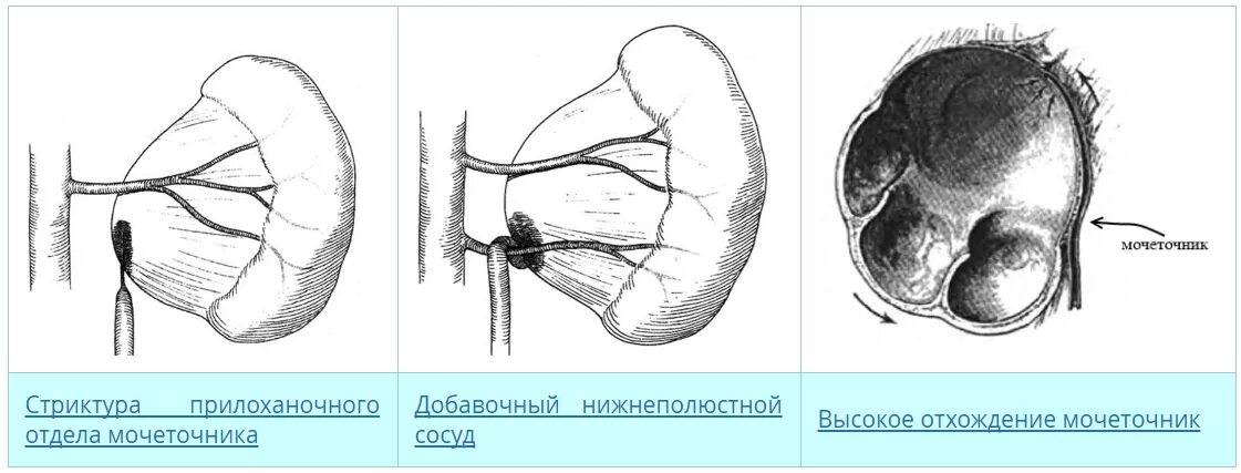 Экстраренальная лоханка. Типы лоханок почек. Типы строения лоханки почки. Анатомия чашечно-лоханочной системы почек. Экстраренальная лоханка.