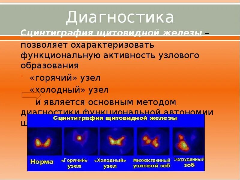 Сцинтиграфия щитовидной железы. Холодный узел щитовидной железы сцинтиграфия. Узловой зоб щитовидной железы. Многоузловой зоб лечение