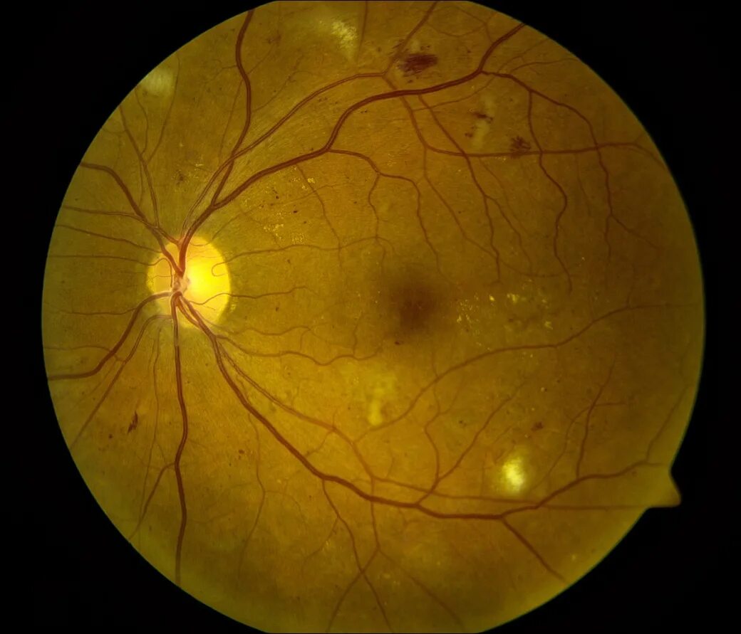 Диабетическая ретинопатия глаз. Геморрагическая ретинопатия. Аутоиммунная ретинопатия. Анемическая ретинопатия.
