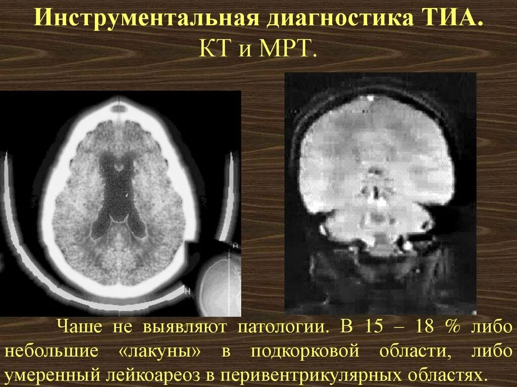 Транзиторно ишемические атаки. Кт головного мозга при транзиторной ишемической атаке. Мрт при транзиторной ишемической атаке. Кт головного мозга при Тиа. Транзиторная ишемическая атака кт мрт.