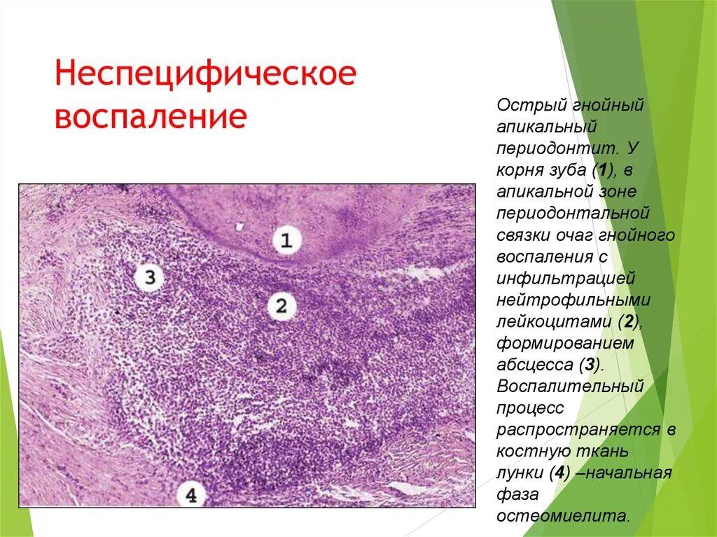 Описание гнойного. Острый Гнойный апикальный периодонтит микропрепарат. Неспецифическое воспаление. Острое гнойное воспаление. Острое неспецифическое воспаление.