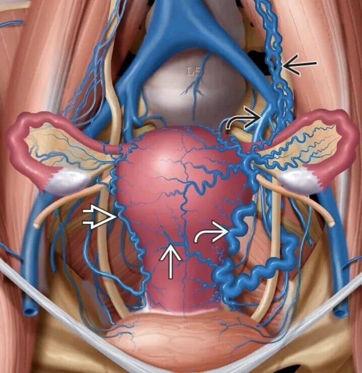 Варикоз малого таза причины. Яичниковая Вена анатомия. Варикозное расширение вен параметрия малого таза. Варикозное расширение вен малого таза у мужчин (ВРВМТ).