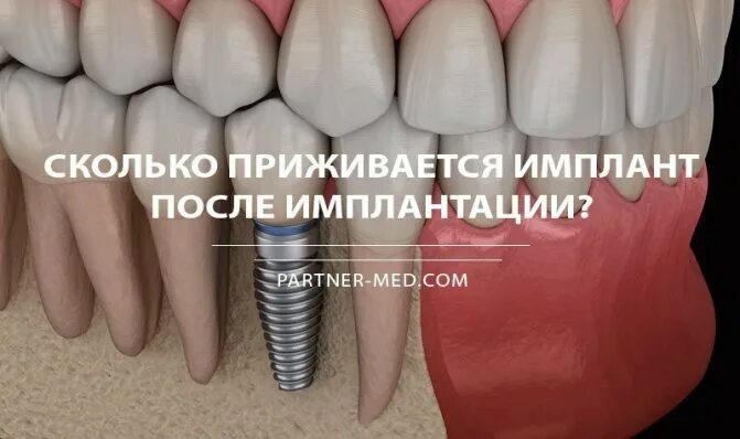 Импланты как долго
